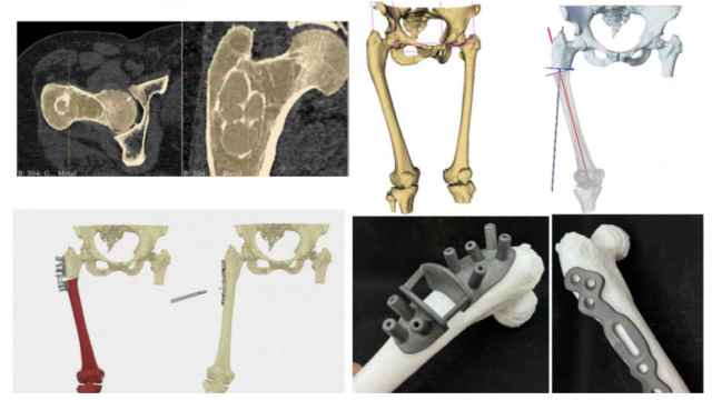 Una recreación de un implante óseo impreso en 3D extraído de uno de los casos clínicos del Hospital Gregorio Marañón.