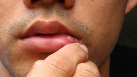 Una llaga que no cura es uno de los síntomas de alarma del cáncer oral.