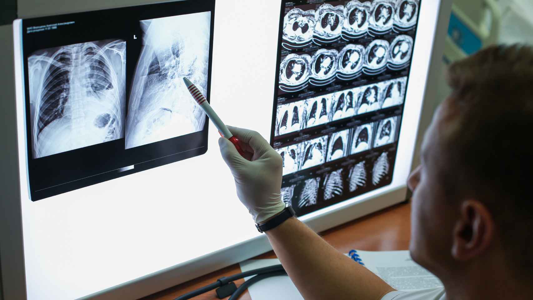Diagnóstico de cáncer de pulmón con rayos X