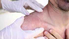 En 2023 se diagnosticaron 3.377 casos de melanoma maligno cutáneo en hombres.
