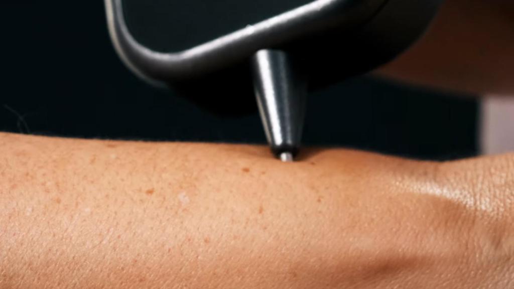 Análisis de una lesión cutánea con DermaSensor