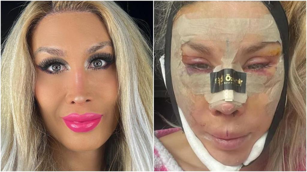 La Pelopony, antes y después de sus seis operaciones.