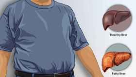 Ilustración del hígado graso.