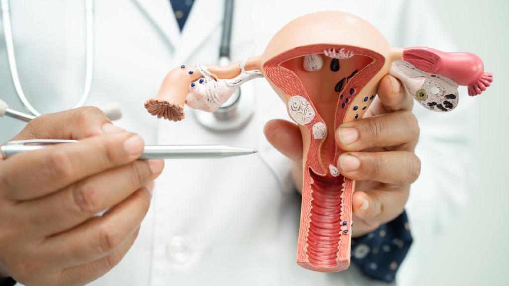 Hasta un 13% de las mujeres sufren del síndrome del ovario poliquístico.