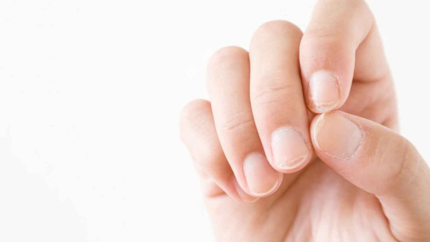 La onicosquicia es un problema en las uñas que lo padecen entre el 27% y el 35% de la población española.