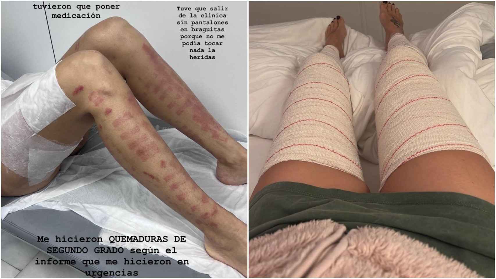 Las piernas de Adara tras el tratamiento.
