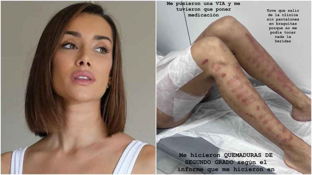 A la izquierda, Adara Molinero. A la derecha, el resultado de sus piernas tras el tratamiento al que se ha sometido.
