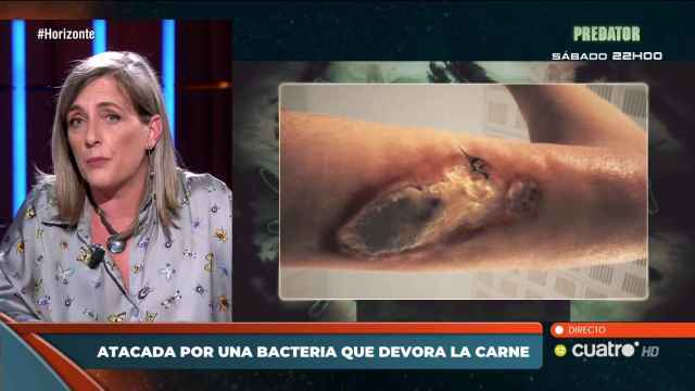 El brazo de Patricia Casas devorado por la bacteria
