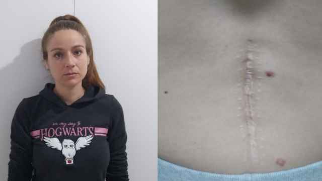 Una fotografía de Nuria Cuenca y su cicatriz en la espalda.