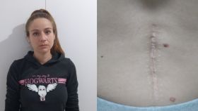 Una fotografía de Nuria Cuenca y su cicatriz en la espalda.