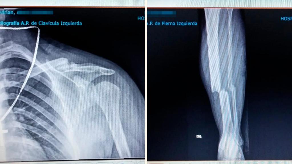 Las radiografías de Adrián con la clavícula rota por tres sitios y la fractura en la tibia y el peroné.