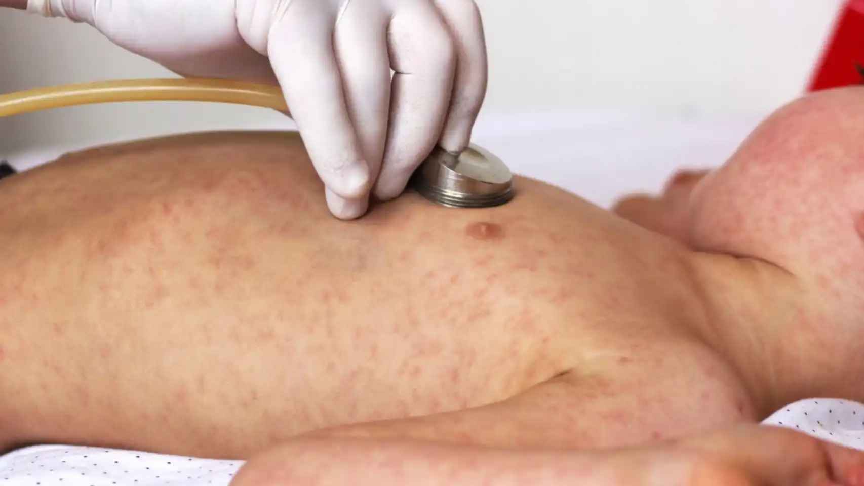 Por qué el sarampión amenaza España pese a ser uno de los países europeos con más vacunados
