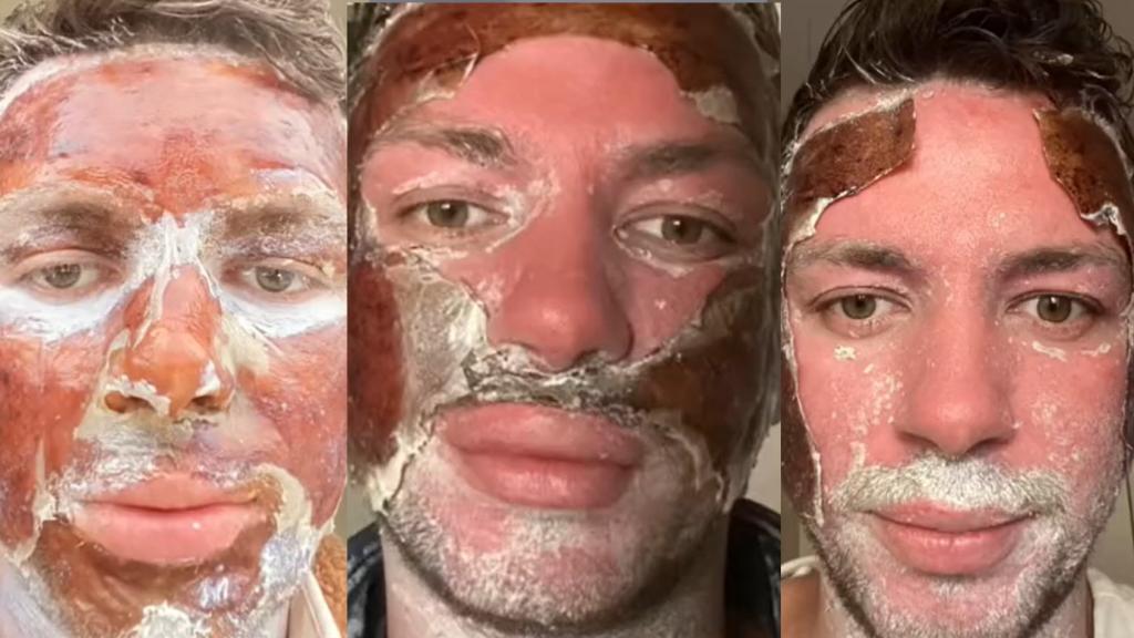 Un 'tiktoker' muestra el proceso de recuperación tras un 'peeling' profundo de fenol.