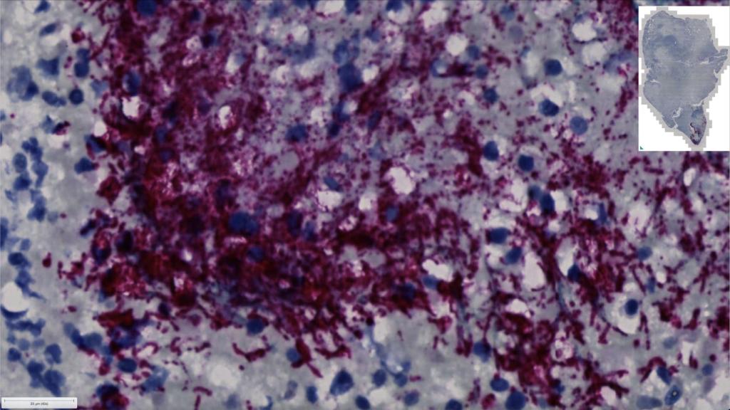 La presencia de Fusobacterium nucleatum (morado) en una muestra de tumor de colon.