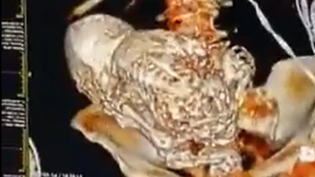 Muere una mujer al intentar extirparle un feto calcificado que tenía desde hace más de 30 años