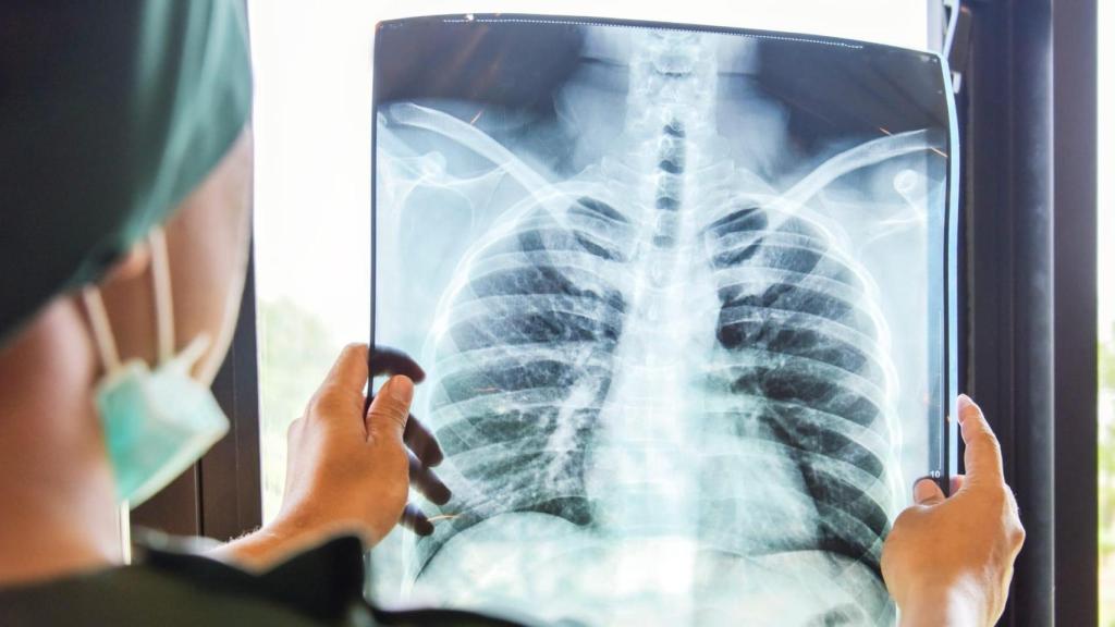 Continúa en Galicia la tendencia descendiente de la tuberculosis, que conmemora hoy su Día Mundial