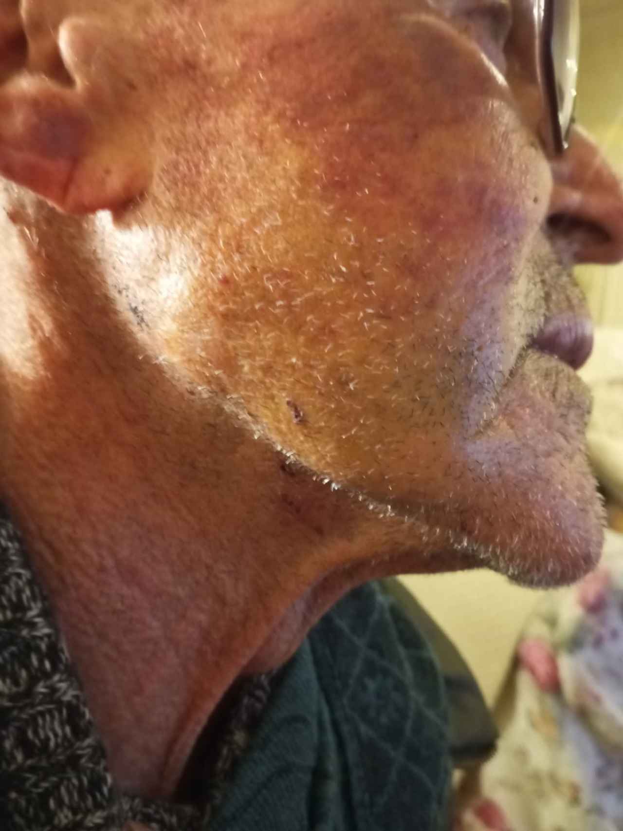 Un detalle del rostro de Julio, todavía amoratado, días después del robo, donde se aprecian tres pequeñas cicatrices por los pinchazos que recibió en el cuello con un cuchillo de cocina.