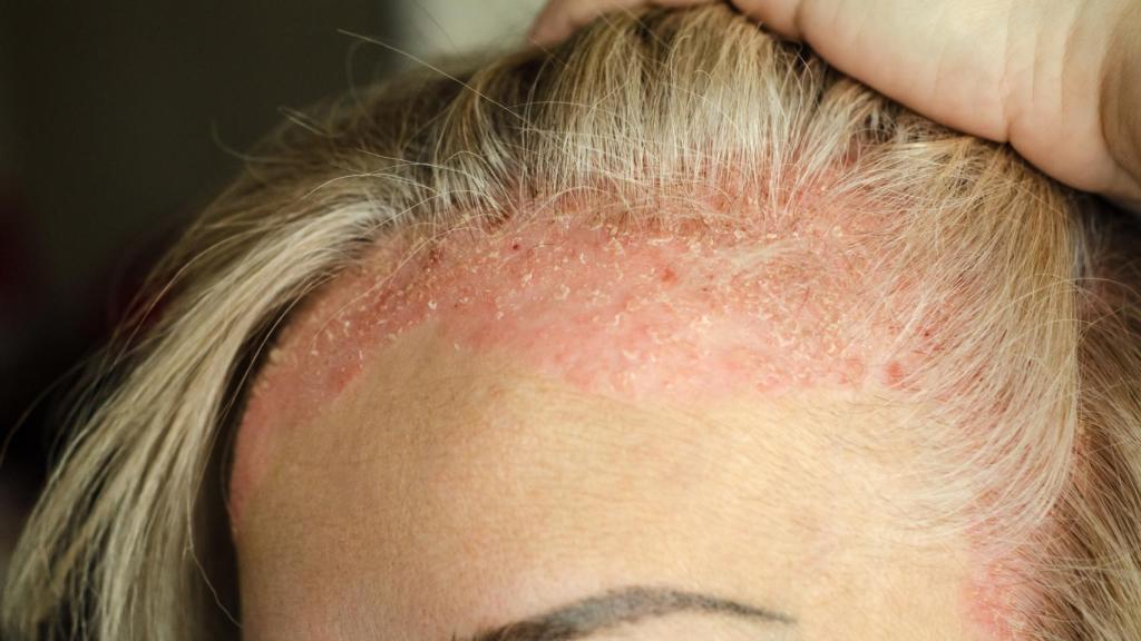 La psoriasis suele salir en articulaciones o zonas cercanas al hueso, como el cuero cabelludo.
