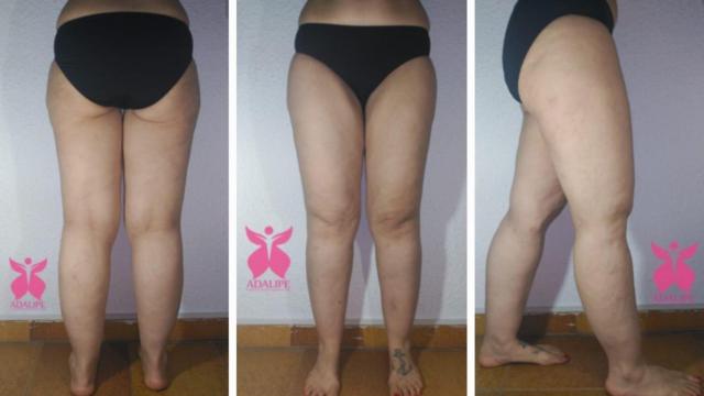 Afectación del lipedema a las piernas