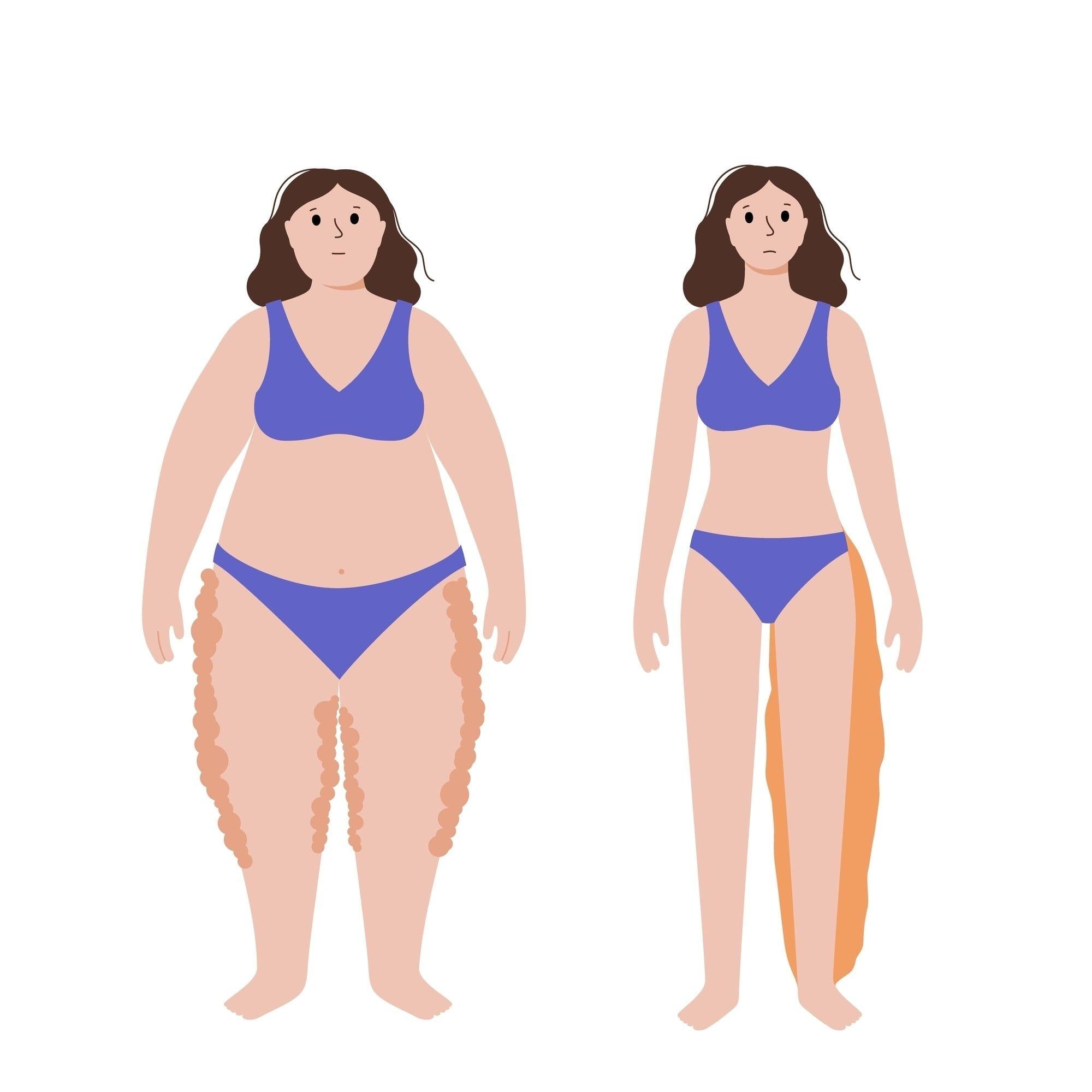 Diferencia entre lipedema (izquierda) y linfedema (derecha) – Shutterstock