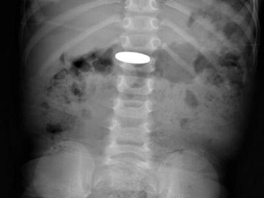 Radiografía de un niño que ha ingerido una moneda