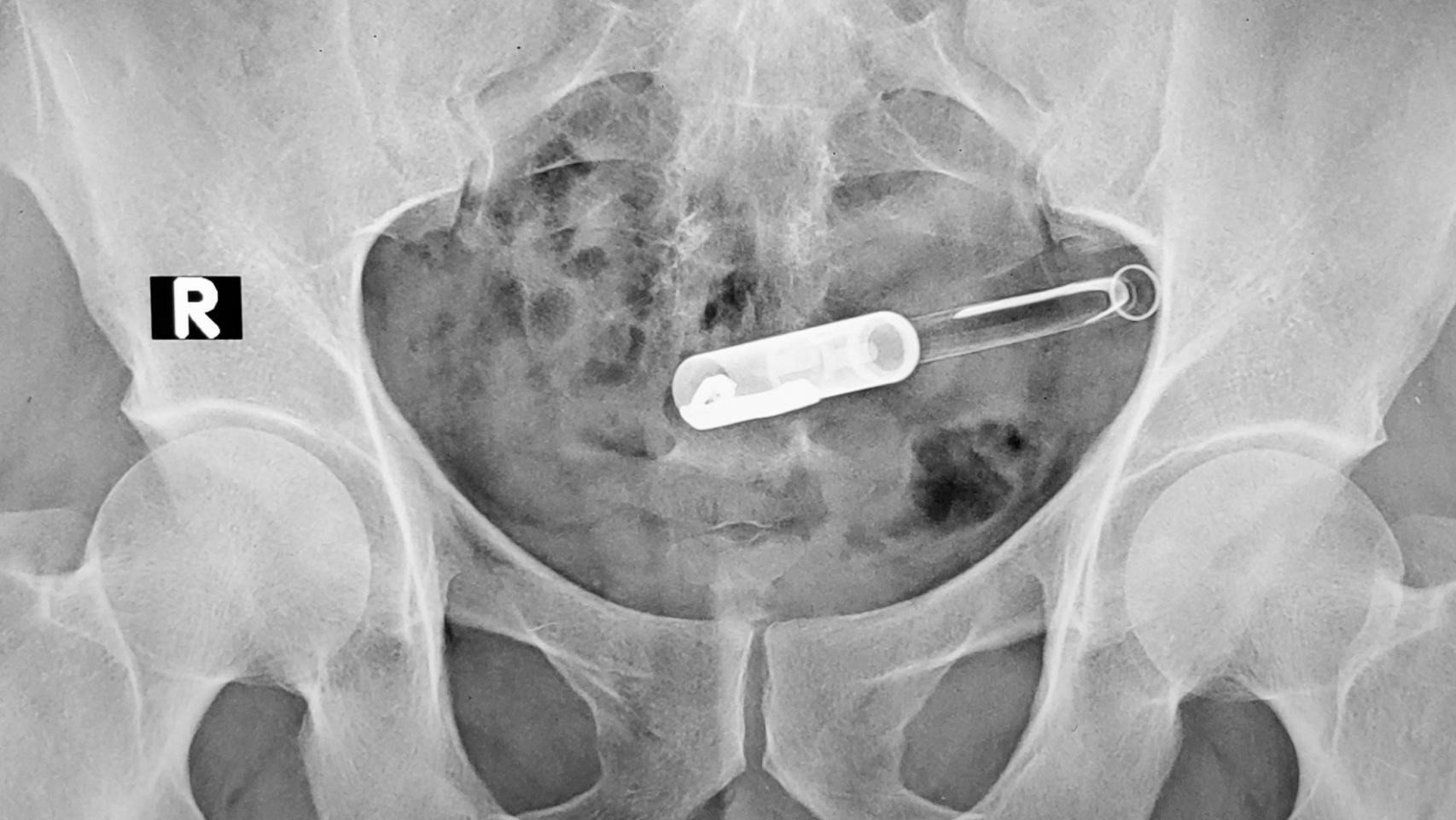 Un bolígrafo dentro de la cavidad anal.