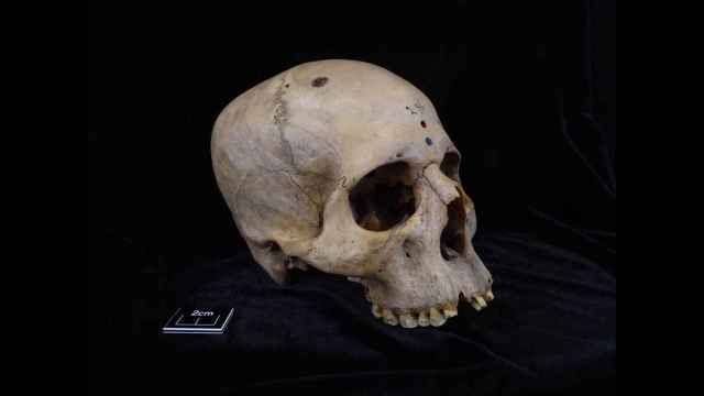 Cráneo de un individuo egipcio de hace unos 4.500 años que sufrió cáncer.