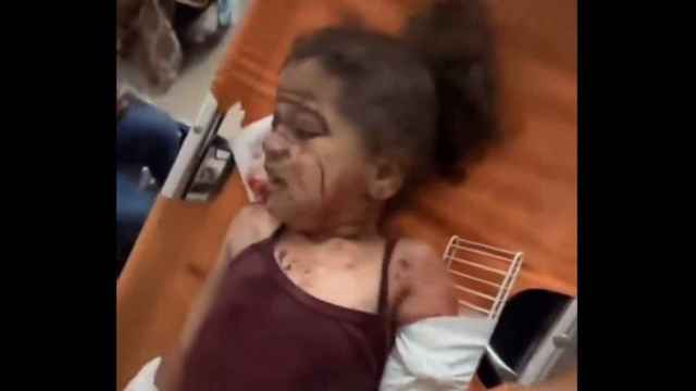 Imagen de una niña palestina herida grave tras el segundo ataque de Israel contra una escuela de la ONU en 24 horas.