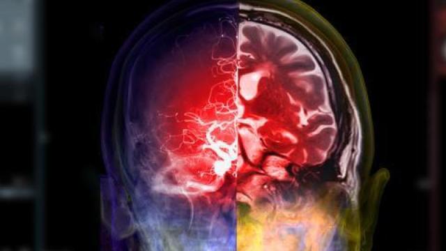Los nuevos fármacos contra el alzhéimer buscan eliminar las placas amiloides del cerebro.