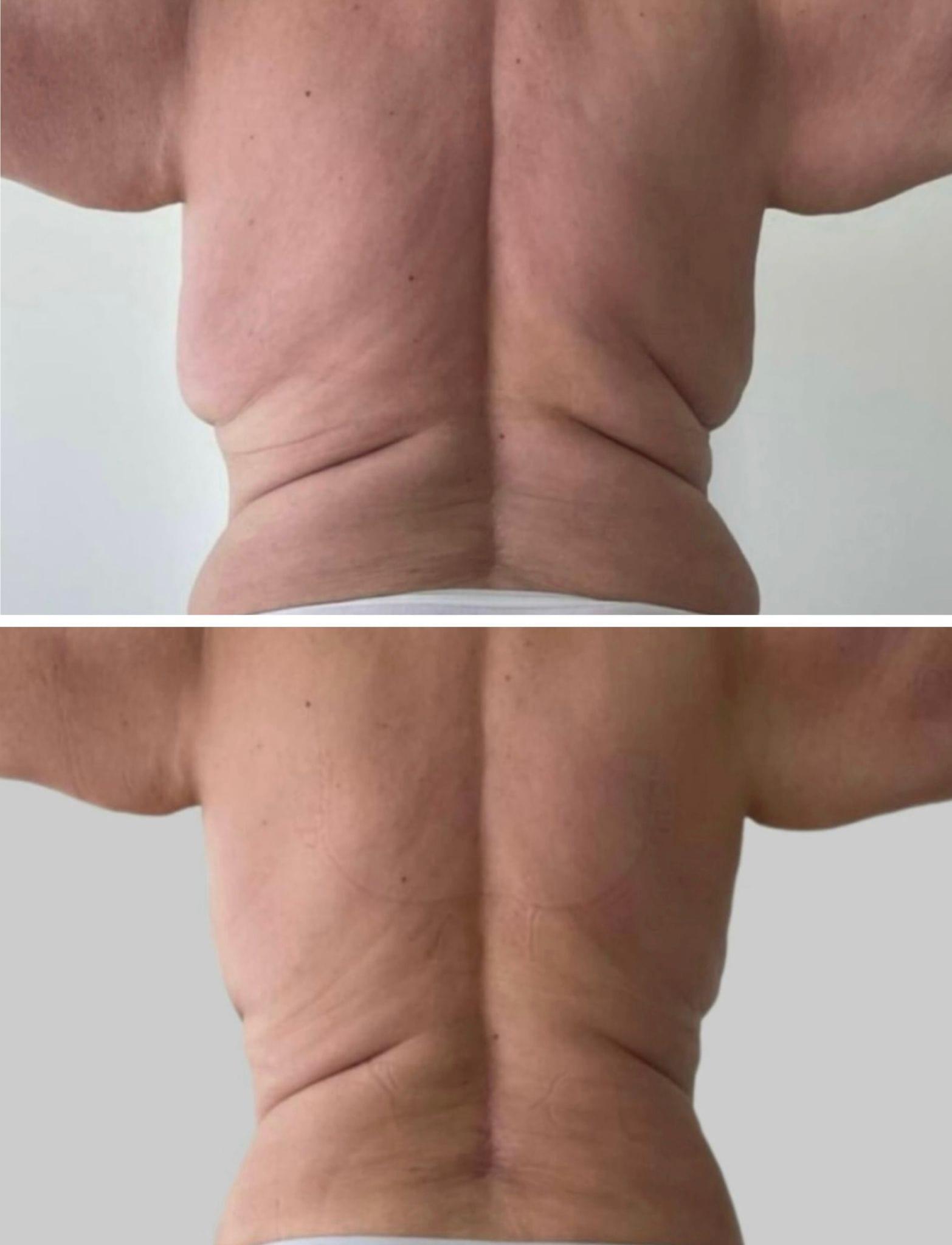 Antes y después de realizar un tratamiento de espalda.