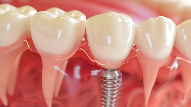 Sin dolor en el dentista: ¿Es posible colocarse implantes sin molestias en A Coruña?