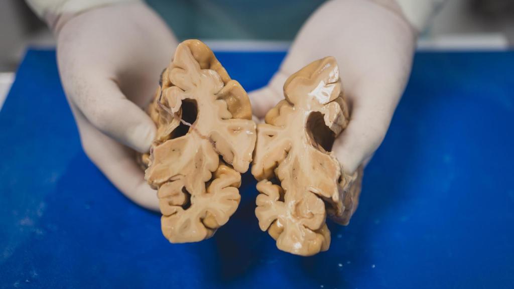 Rábano muestra el estado del cerebro de un donante con alzhéimer avanzado.