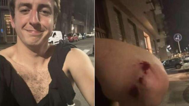 Las heridas del periodista del periódico 'La Stampa', Andrea Joly, tras ser agredido por militantes de ultraderecha en Turín.