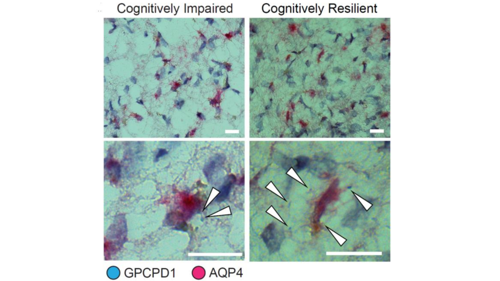 Densidad de la expresión de genes en las neuronas de un paciente con deterioro cognitivo (izquierda) y resiliente (derecha).