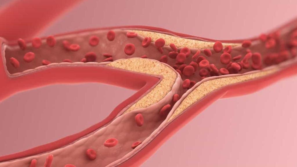 Representación de la ateroesclerosis. Scientific Animations.