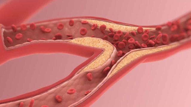 Representación de la ateroesclerosis. Scientific Animations.