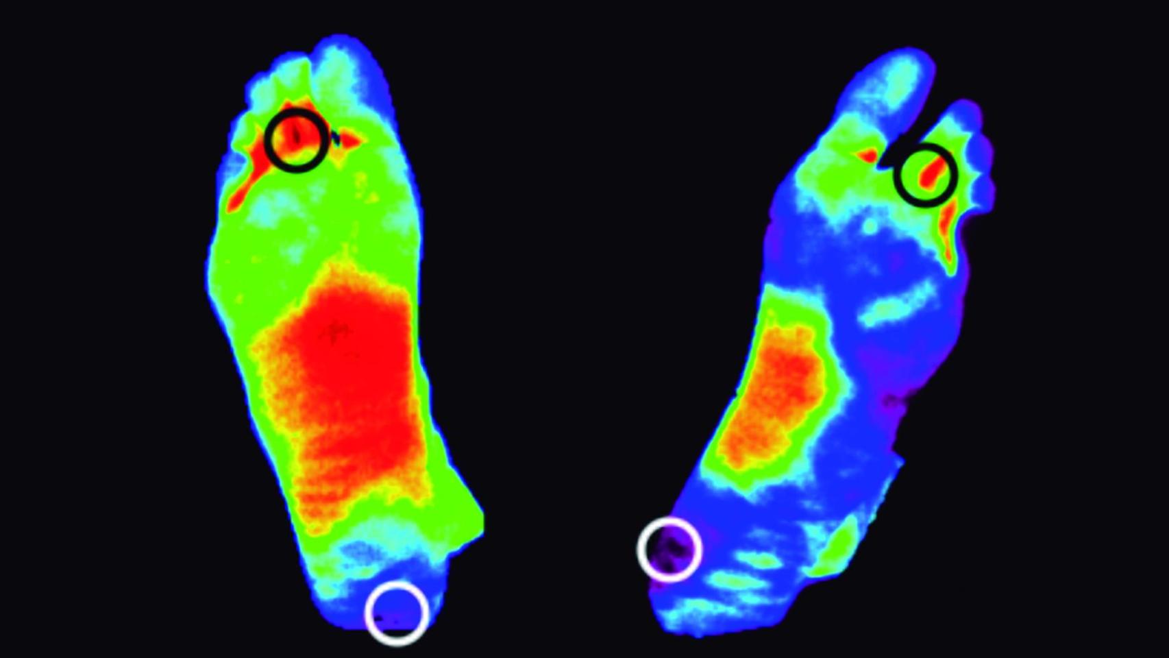 Prevención de pie dabético con termografía.