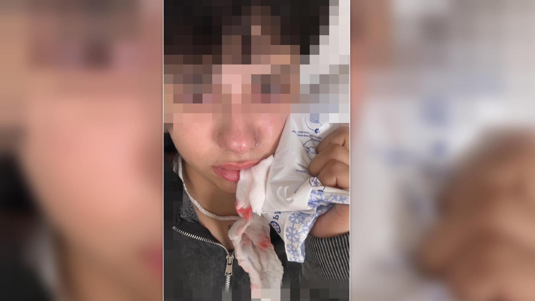 La joven vallisoletana agredida muestra las secuelas