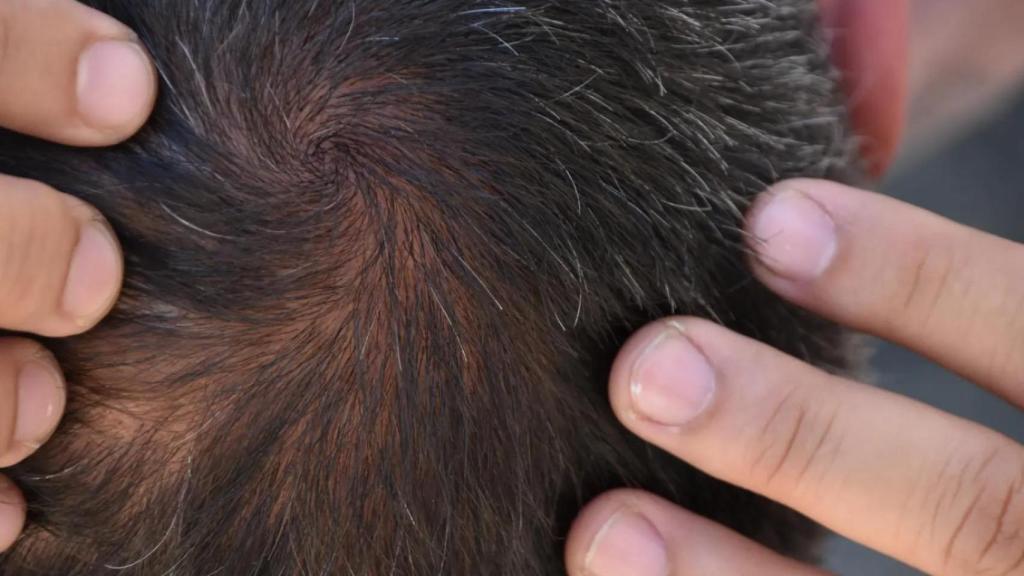 Un 42,6% de los españoles sufre de alopecia.