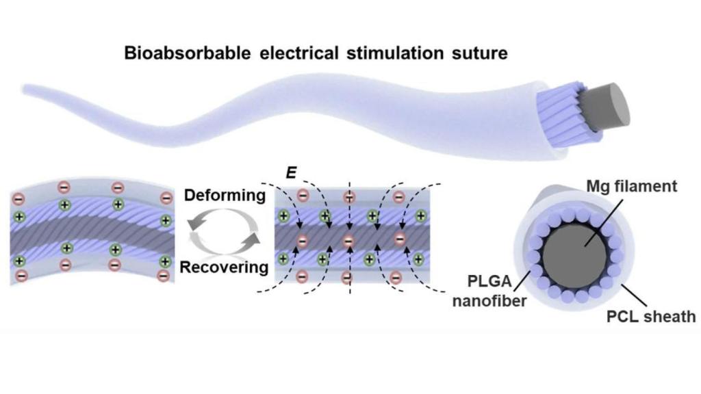 Ilustración de sutura bioabsorbible para estimulación eléctrica.