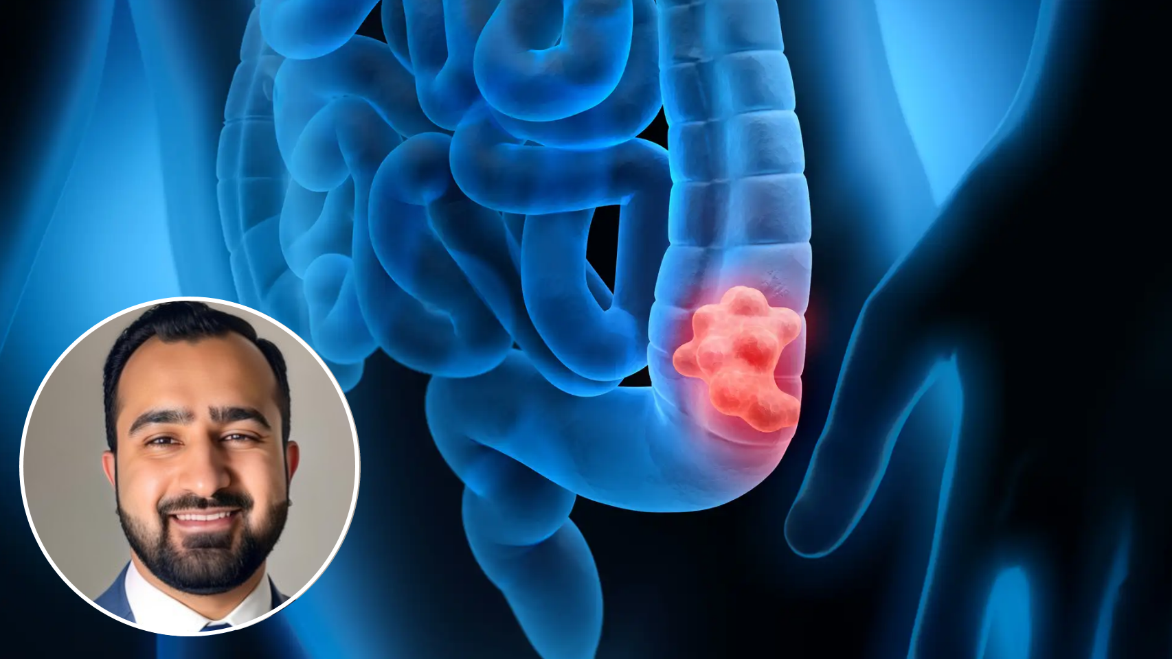 I’m an oncologist and here are five symptoms that indicate you are suffering from colorectal cancer: They are very unknown in Spain.