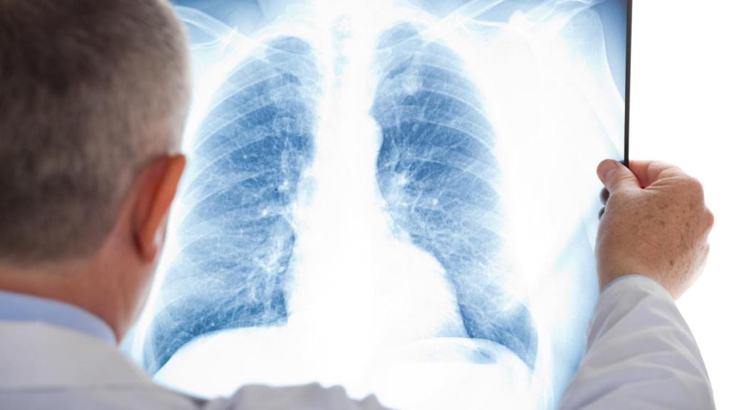 Un doctor estudiando una radiografía de los pulmones