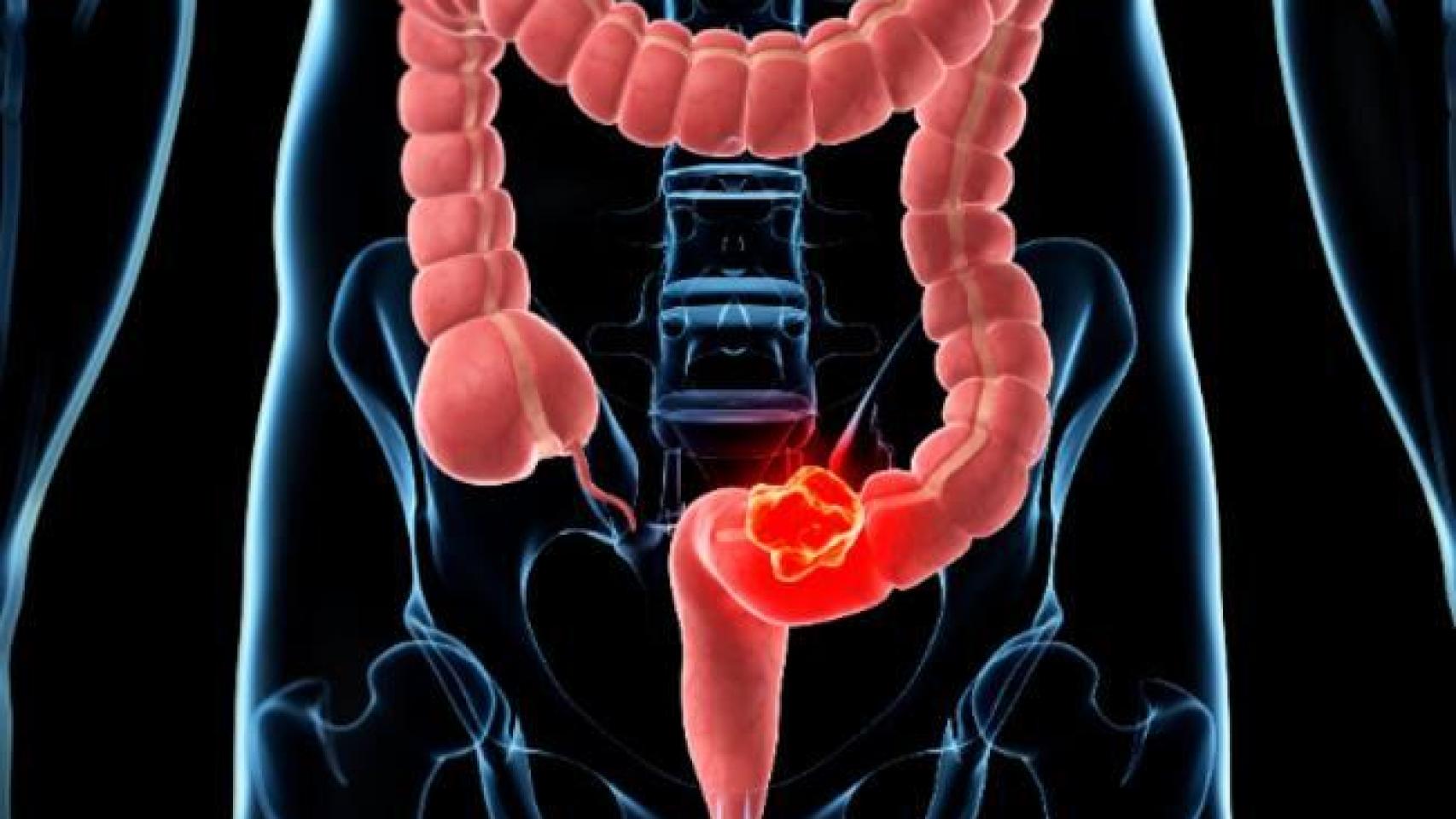 Representación del cáncer colorrectal.