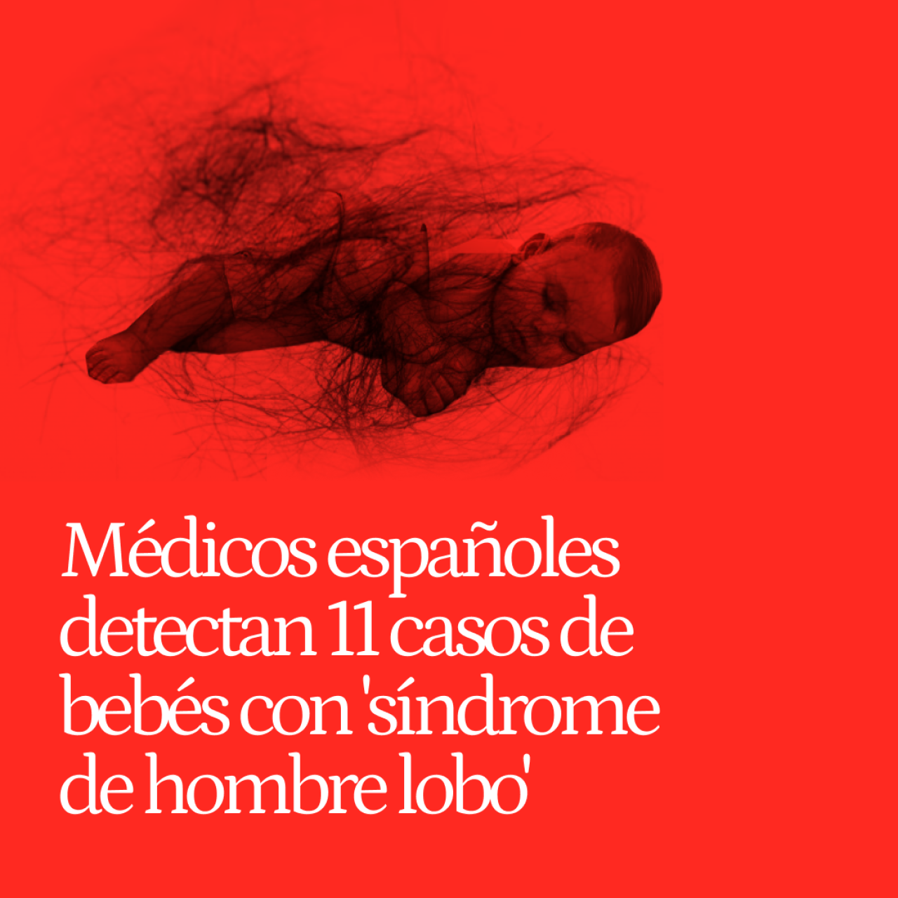 Médicos españoles detectan 11 casos de bebés con 'síndrome de hombre lobo': sus padres usaban tratamientos contra la calvicie