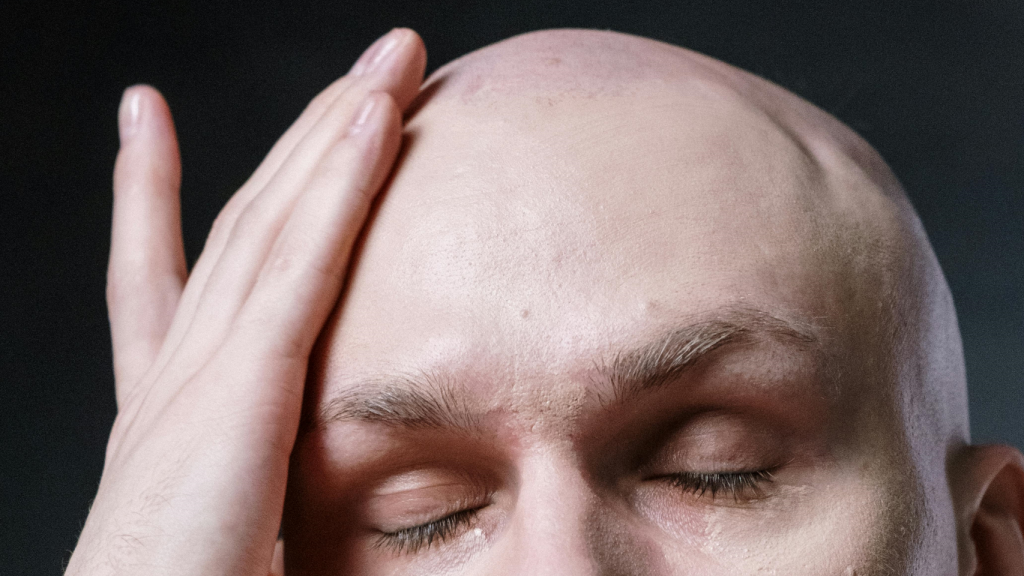 Alopecia androgenética.