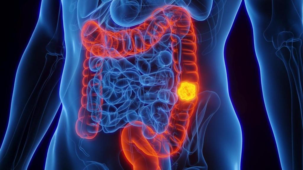 Representación gráfica de un cáncer de colon.