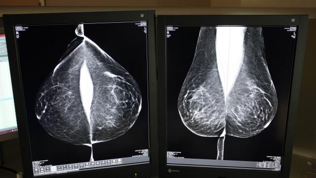 Una mamografía en el Hospital Río Hortega de Valladolid
