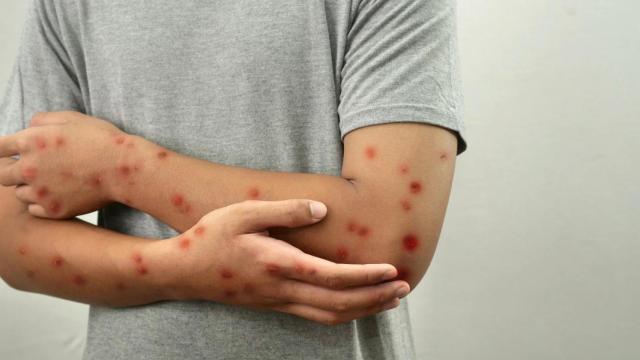 Marcas visibles de la enfermedad del sarampión.