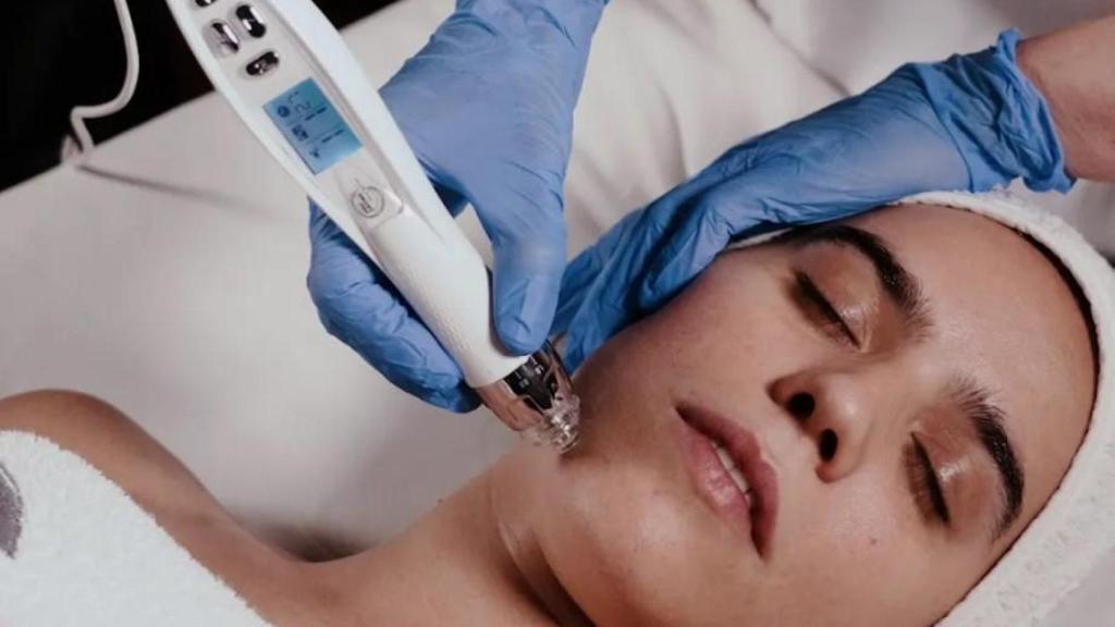 Tratamiento con exosomas en clínicas Carmen Navarro mediante microagujas.