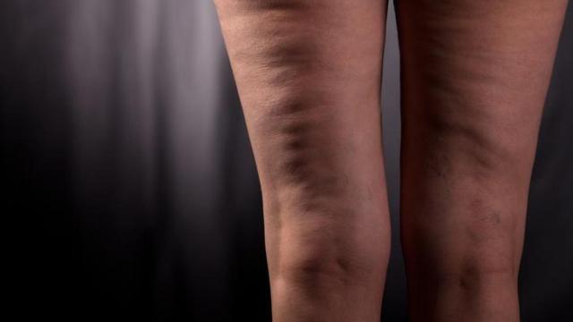Piernas de mujer con problemas de circulación.